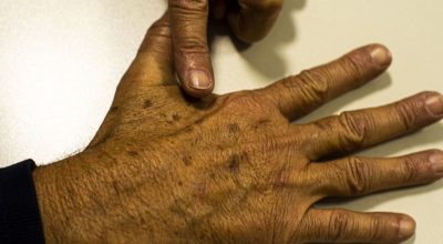 Desinformação sobre câncer de pele afeta diagnóstico, diz instituição