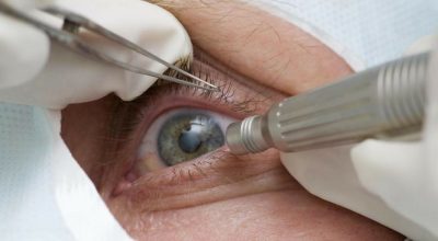 Lula faz cirurgia de catarata; entenda a doença e o procedimento