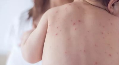 Estado de São Paulo reforça necessidade de vacinação contra o sarampo